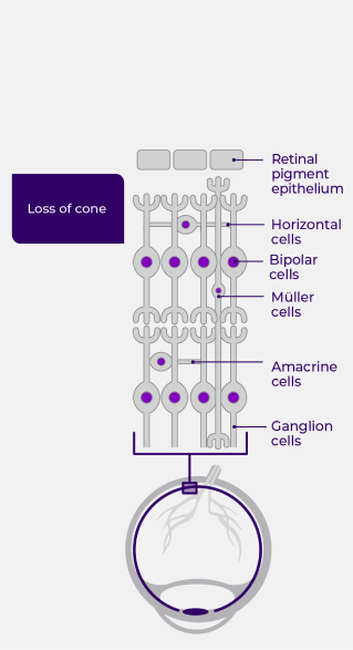 Anatomical impact of x-linked retinitis pigmentosa (XLRP) in stage 4: All photoreceptors are lost