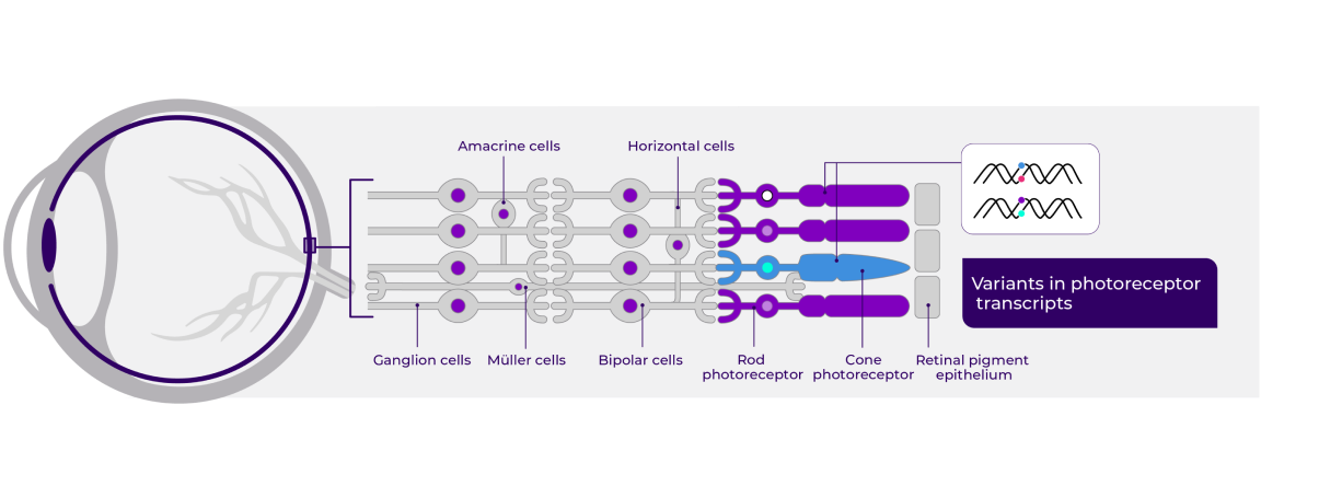 Anatomical impact of x-linked retinitis pigmentosa (XLRP) in stage 1: Variants in photoreceptors lead to degeneration