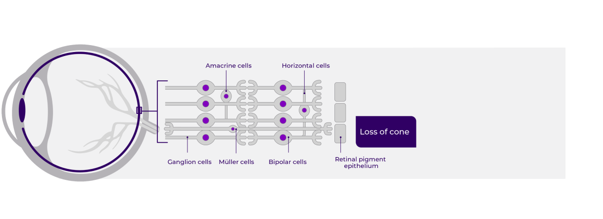 Anatomical impact of x-linked retinitis pigmentosa (XLRP) in stage 4: All photoreceptors are lost