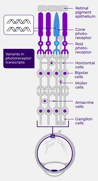 Anatomical impact of x-linked retinitis pigmentosa (XLRP) in stage 1: Variants in photoreceptors lead to degeneration